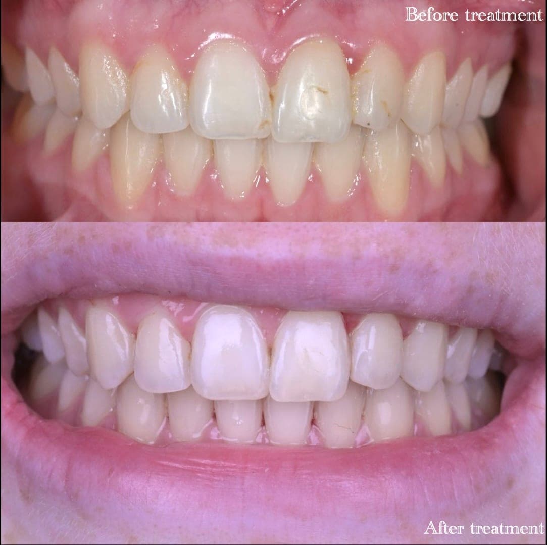 Teeth Whitening