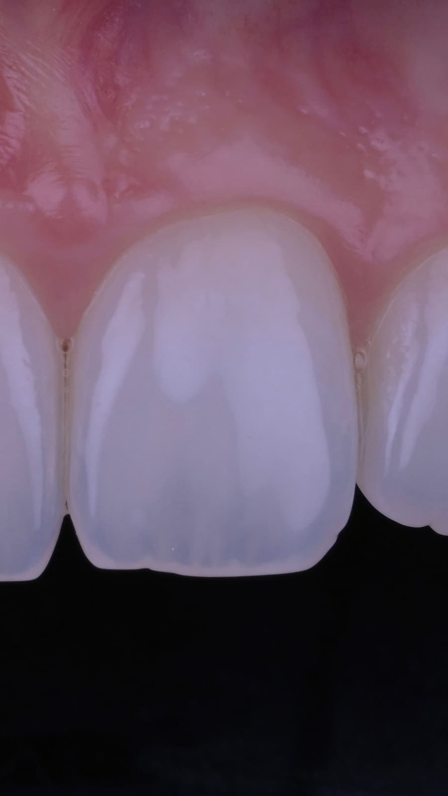 Teeth Whitening