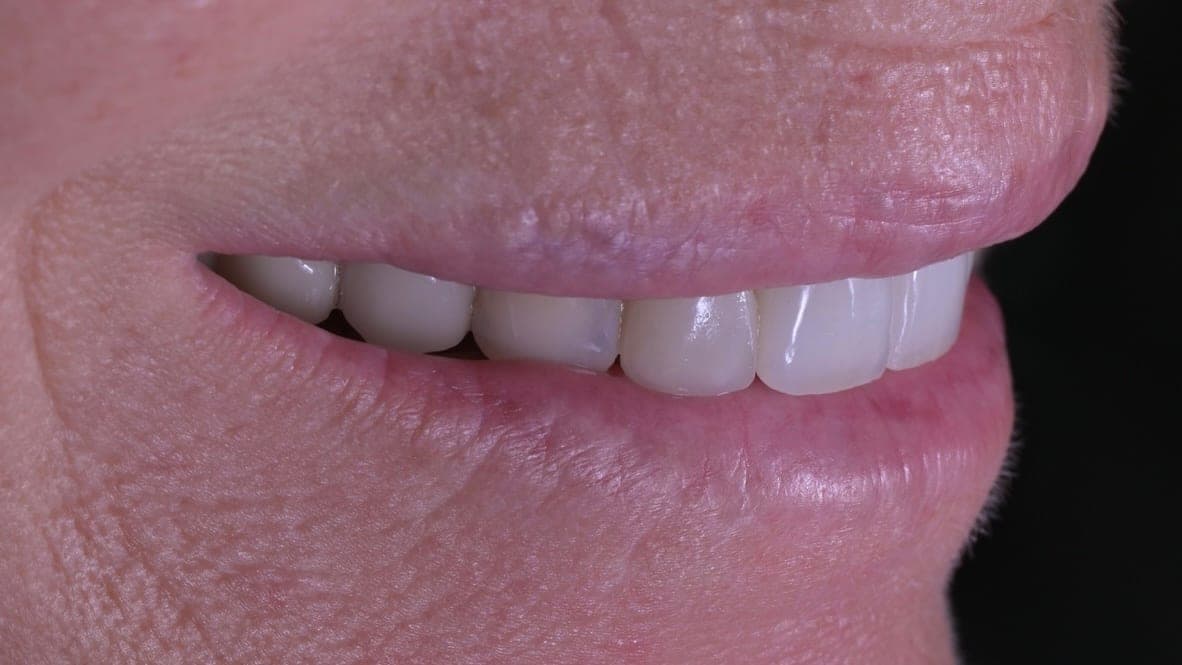 Ceramic Veneers